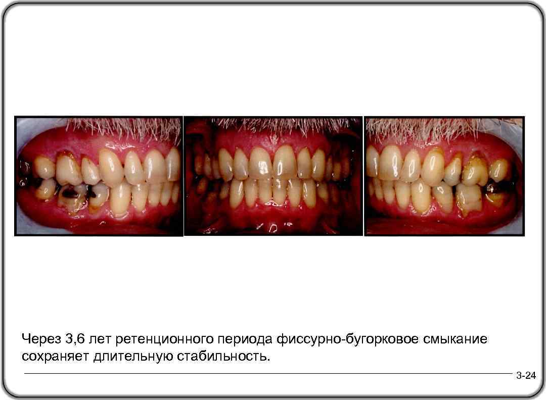 Через 3, 6 лет ретенционного периода фиссурно-бугорковое смыкание сохраняет длительную стабильность. 3 -24 