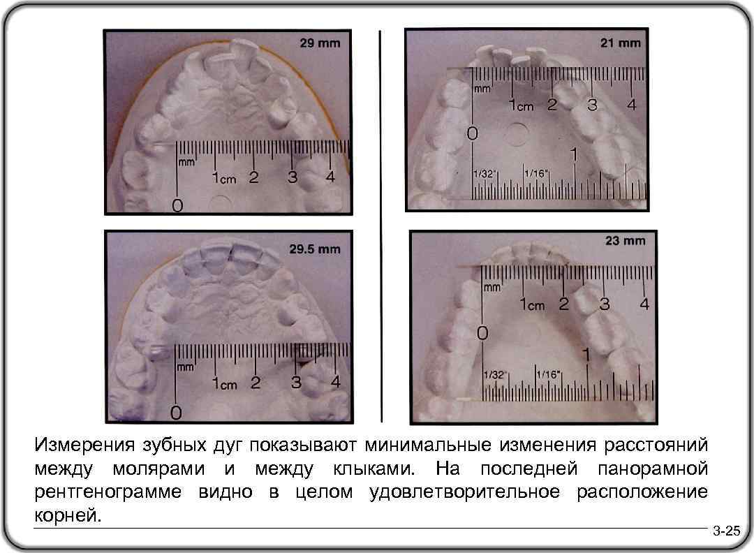 Измерения зубных дуг показывают минимальные изменения расстояний между молярами и между клыками. На последней