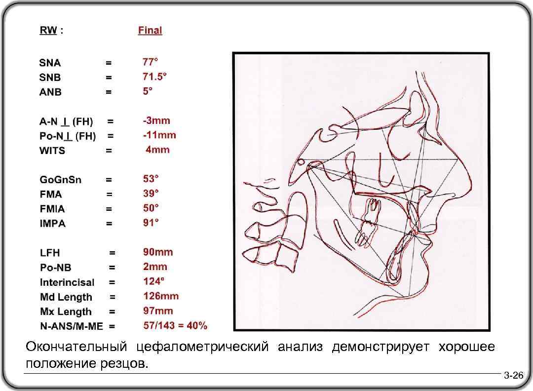 Окончательный цефалометрический анализ демонстрирует хорошее положение резцов. 3 -26 