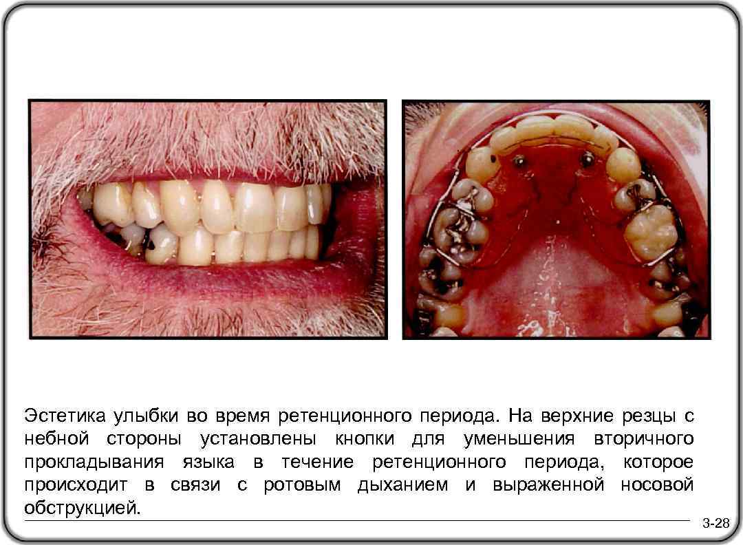 Эстетика улыбки во время ретенционного периода. На верхние резцы с небной стороны установлены кнопки