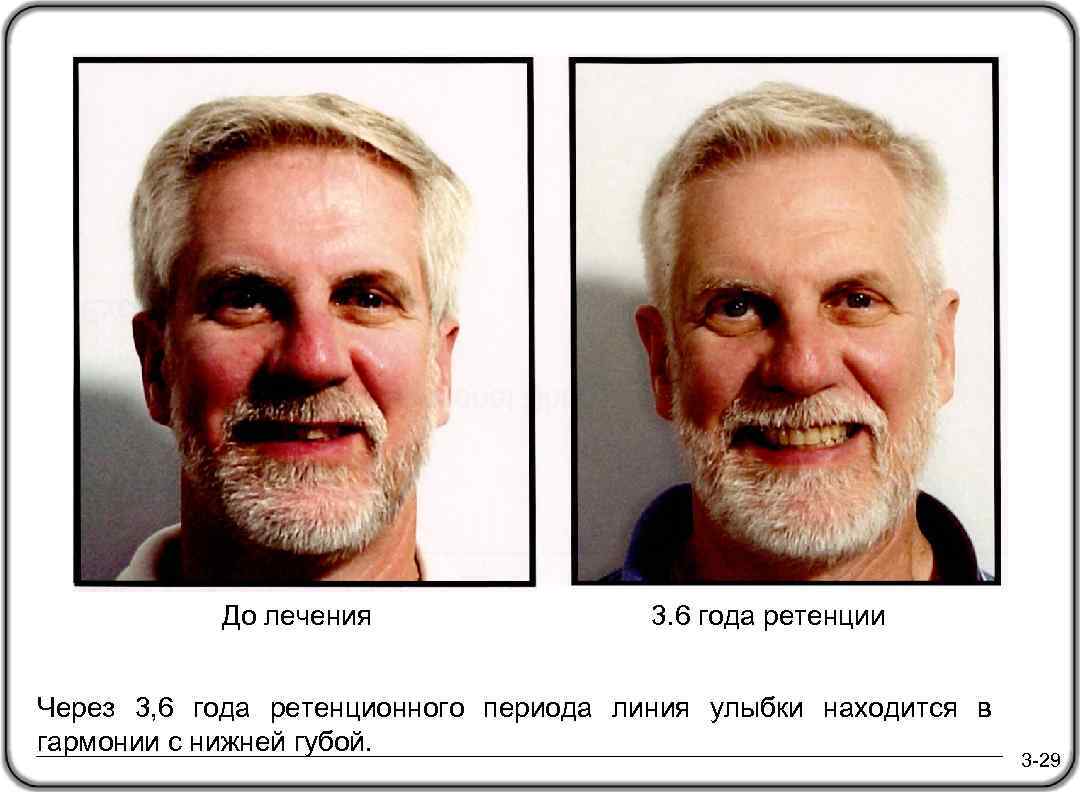 До лечения 3. 6 года ретенции Через 3, 6 года ретенционного периода линия улыбки