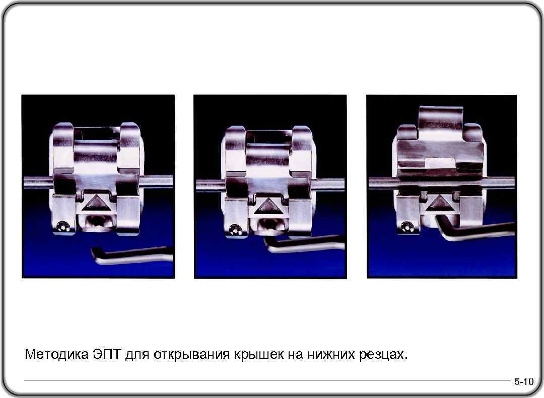 Методика ЭПТ для открывания крышек на нижних резцах. 5 -10 