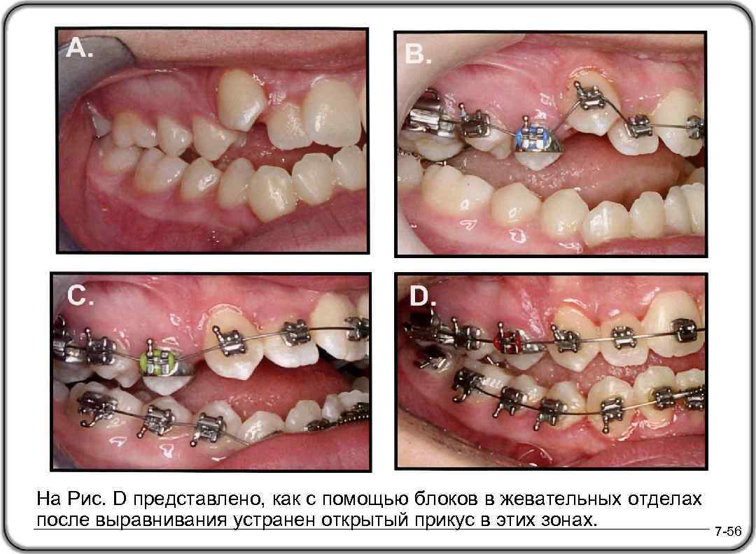 На Рис. D представлено, как с помощью блоков в жевательных отделах после выравнивания устранен