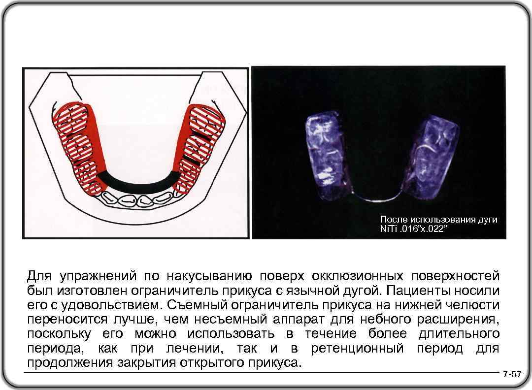 После использования дуги Ni. Ti. 016”x. 022” Для упражнений по накусыванию поверх окклюзионных поверхностей