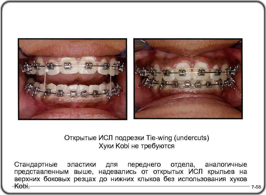 Открытые ИСЛ подрезки Tie-wing (undercuts) Хуки Kobi не требуются Стандартные эластики для переднего отдела,