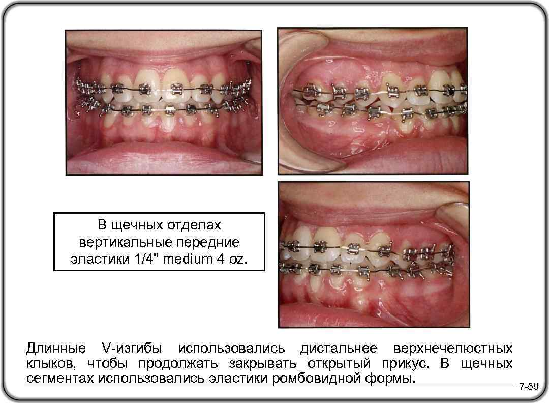 В щечных отделах вертикальные передние эластики 1/4