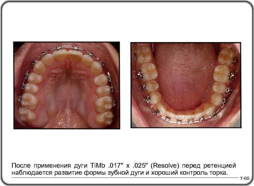 После применения дуги Ti. Mb. 017