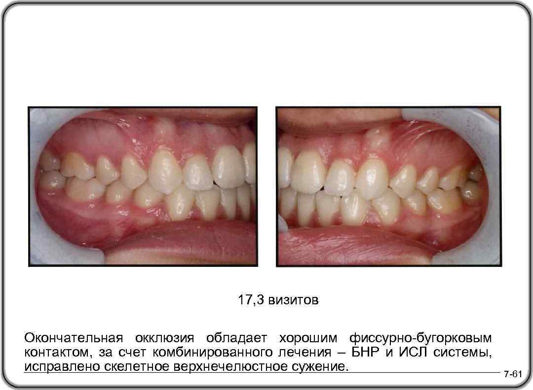 17, 3 визитов Окончательная окклюзия обладает хорошим фиссурно-бугорковым контактом, за счет комбинированного лечения –