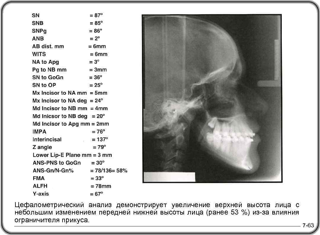 Цефалометрический анализ демонстрирует увеличение верхней высота лица с небольшим изменением передней нижней высоты лица