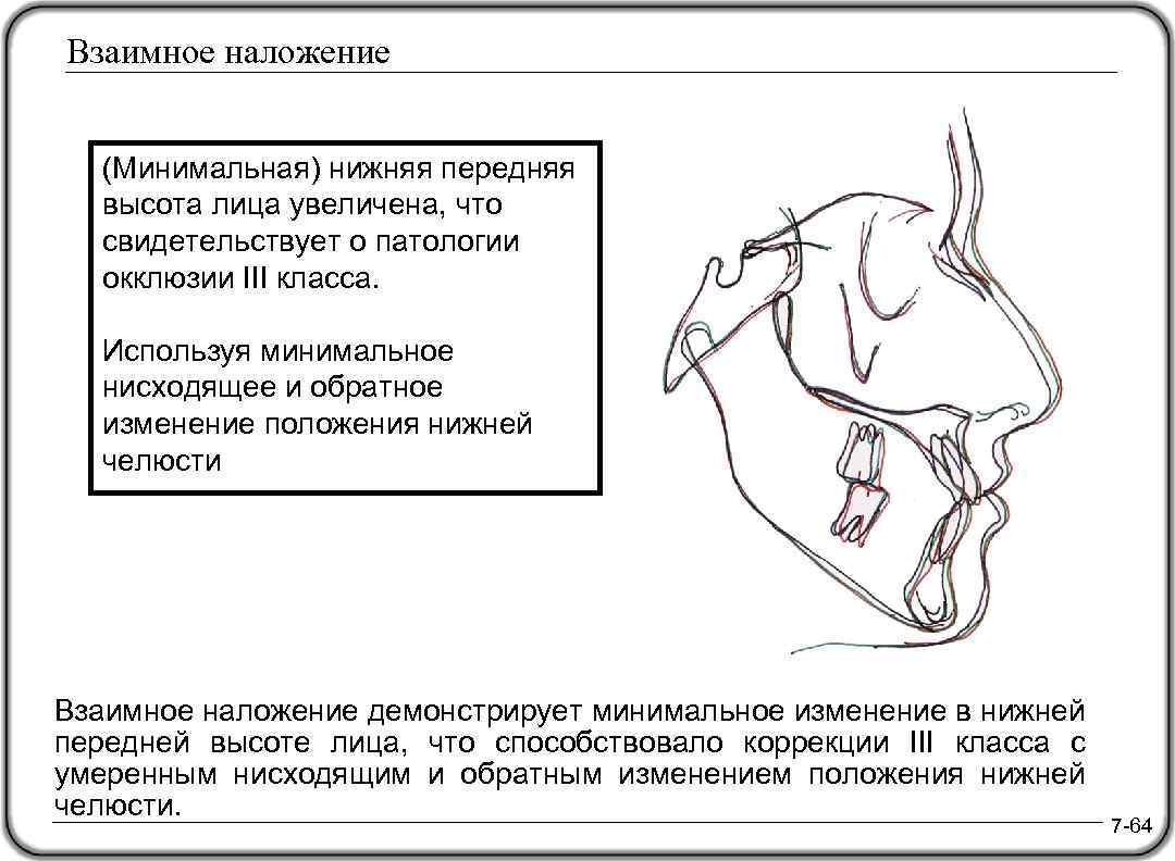 Взаимное наложение (Минимальная) нижняя передняя высота лица увеличена, что свидетельствует о патологии окклюзии III