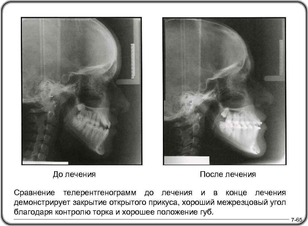 До лечения После лечения Сравнение телерентгенограмм до лечения и в конце лечения демонстрирует закрытие