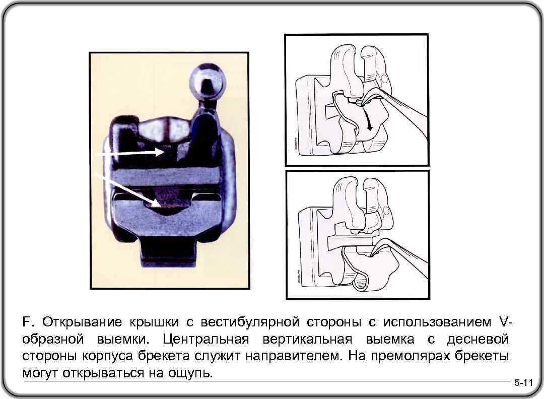 F. Открывание крышки с вестибулярной стороны с использованием Vобразной выемки. Центральная вертикальная выемка с