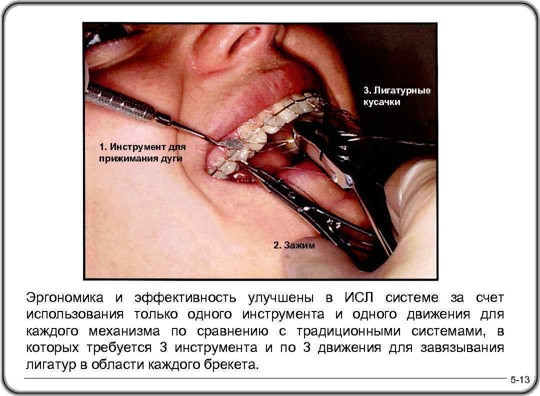 3. Лигатурные кусачки 1. Инструмент для прижимания дуги 2. Зажим Эргономика и эффективность улучшены