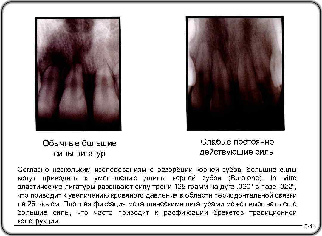 Обычные большие силы лигатур Слабые постоянно действующие силы Согласно нескольким исследованиям о резорбции корней
