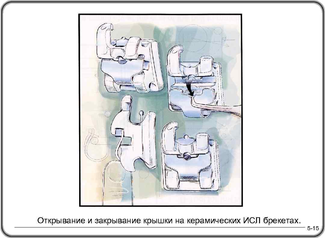 Открывание и закрывание крышки на керамических ИСЛ брекетах. 5 -15 