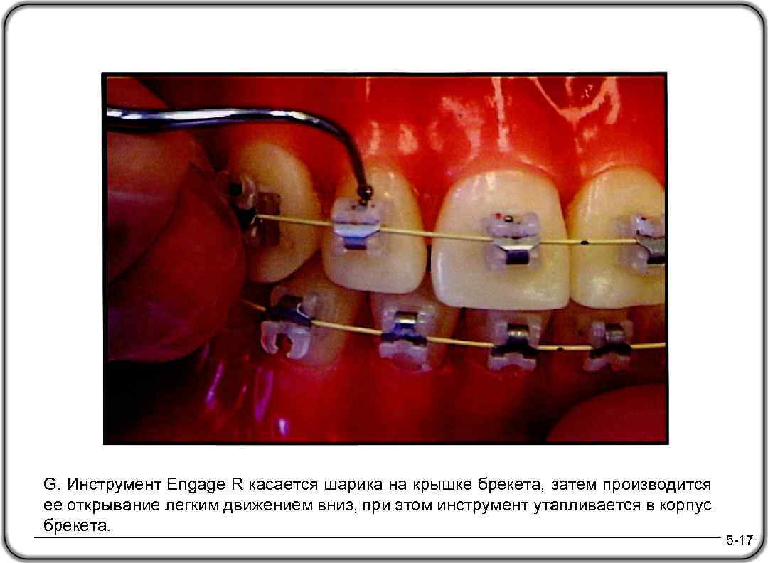 G. Инструмент Engage R касается шарика на крышке брекета, затем производится ее открывание легким