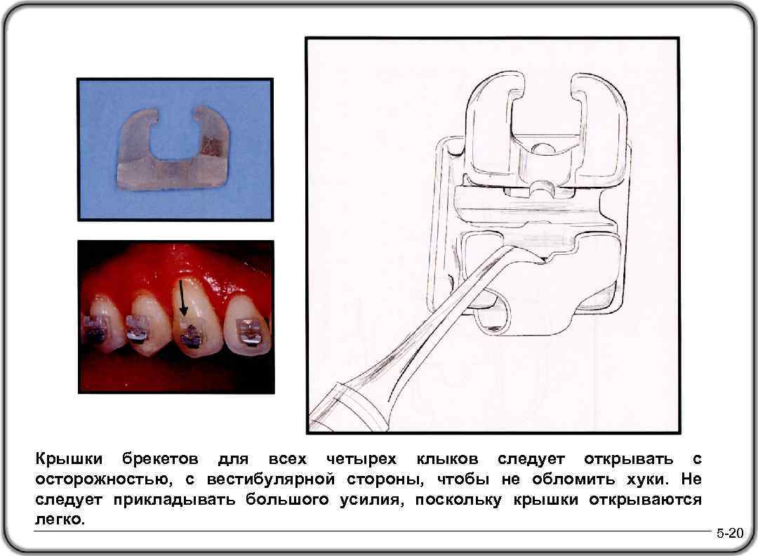 Крышки брекетов для всех четырех клыков следует открывать с осторожностью, с вестибулярной стороны, чтобы