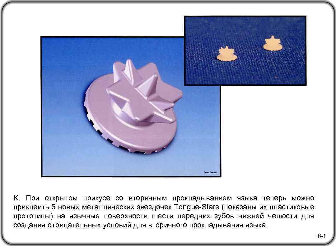K. При открытом прикусе со вторичным прокладыванием языка теперь можно приклеить 6 новых металлических