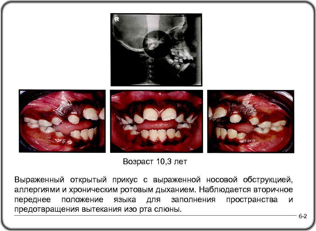 Возраcт 10, 3 лет Выраженный открытый прикус с выраженной носовой обструкцией, аллергиями и хроническим