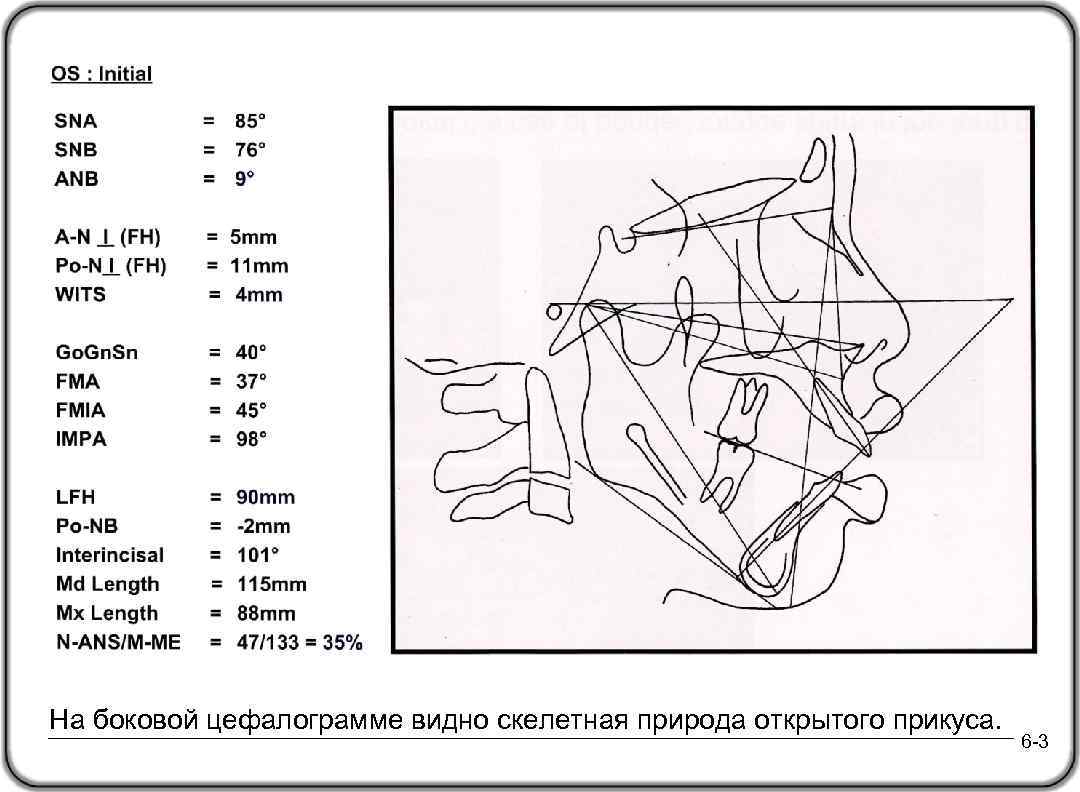 На боковой цефалограмме видно скелетная природа открытого прикуса. 6 -3 