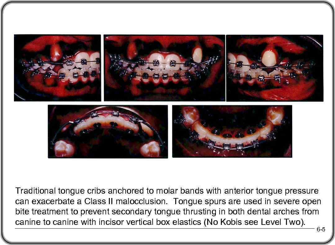 Traditional tongue cribs anchored to molar bands with anterior tongue pressure can exacerbate a