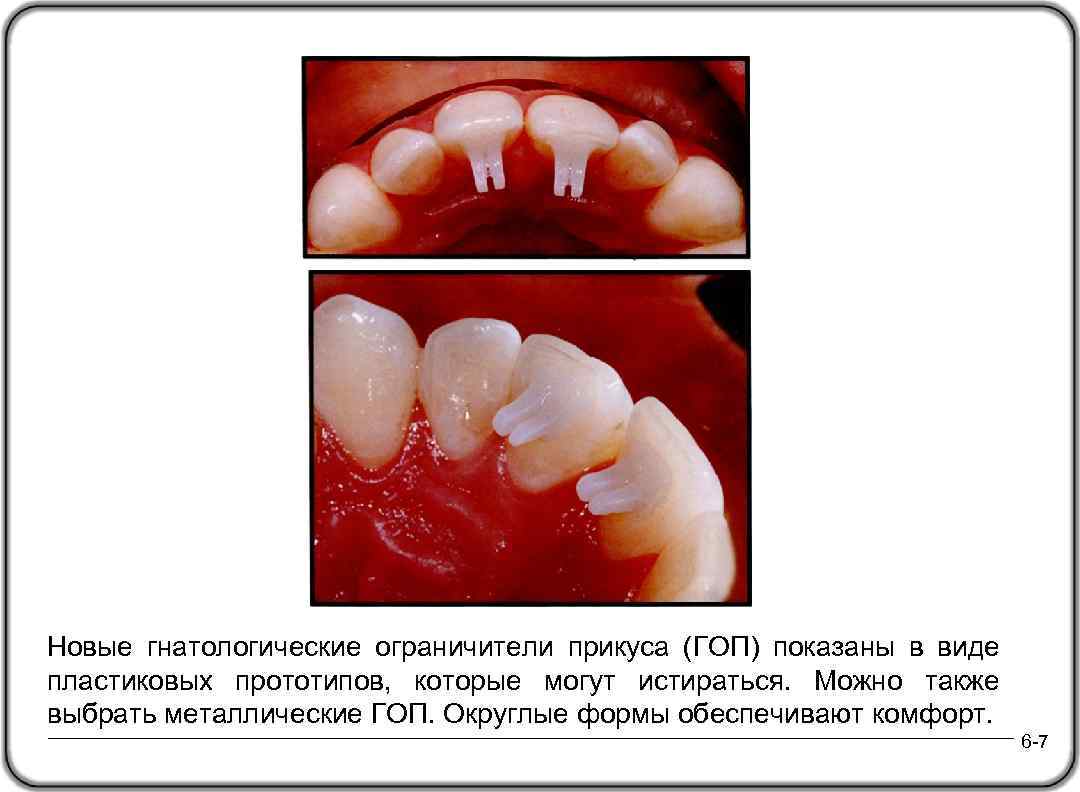Новые гнатологические ограничители прикуса (ГОП) показаны в виде пластиковых прототипов, которые могут истираться. Можно