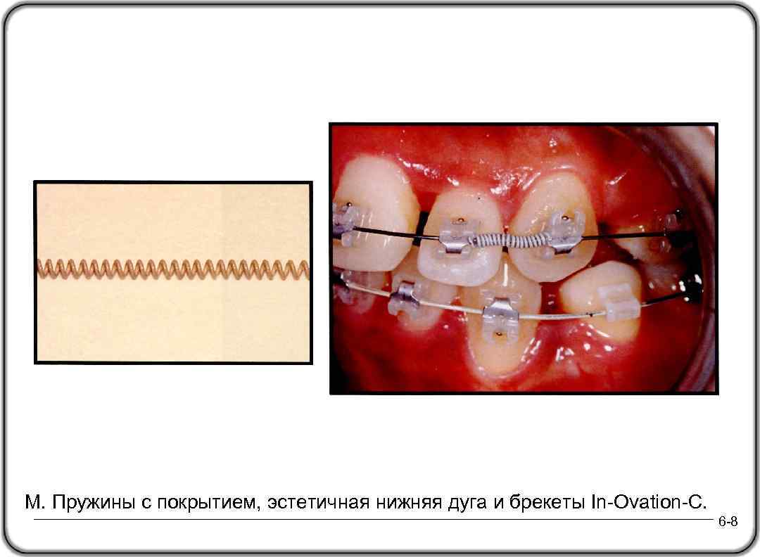 M. Пружины с покрытием, эстетичная нижняя дуга и брекеты In-Ovation-C. 6 -8 