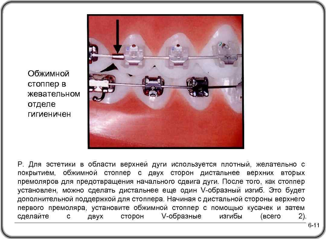Обжимной стоппер в жевательном отделе гигиеничен P. Для эстетики в области верхней дуги используется