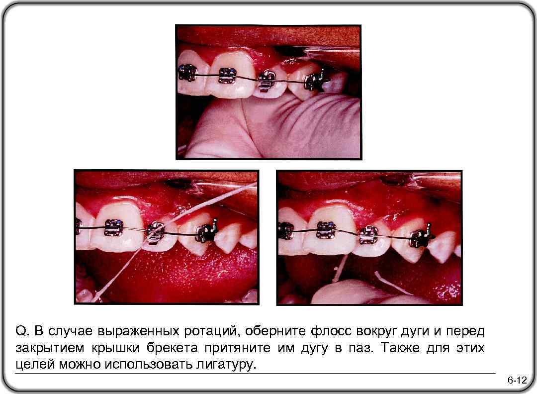 Q. В случае выраженных ротаций, оберните флосс вокруг дуги и перед закрытием крышки брекета