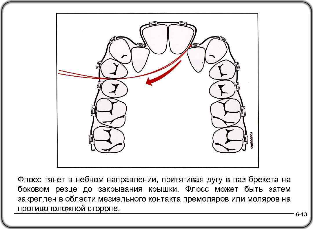 Флосс тянет в небном направлении, притягивая дугу в паз брекета на боковом резце до