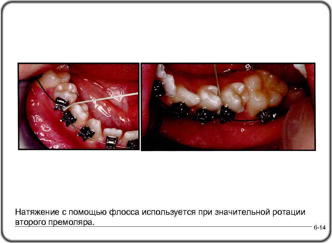 Натяжение с помощью флосса используется при значительной ротации второго премоляра. 6 -14 