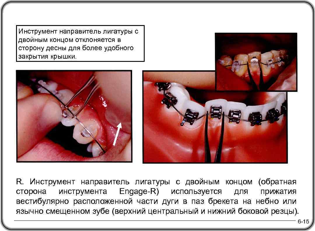 Инструмент направитель лигатуры с двойным концом отклоняется в сторону десны для более удобного закрытия