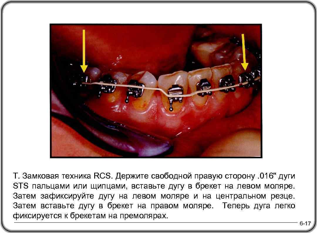 T. Замковая техника RCS. Держите свободной правую сторону. 016