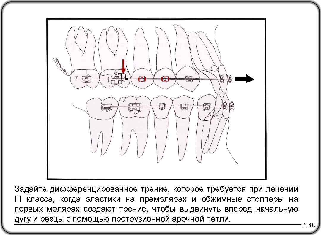 Задайте дифференцированное трение, которое требуется при лечении III класса, когда эластики на премолярах и