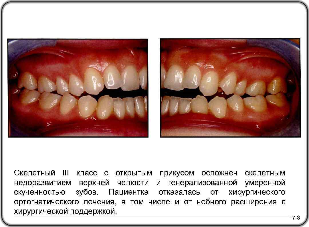 Скелетный III класс с открытым прикусом осложнен скелетным недоразвитием верхней челюсти и генерализованной умеренной