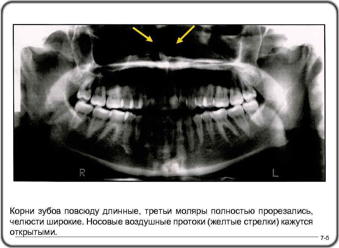 Корни зубов повсюду длинные, третьи моляры полностью прорезались, челюсти широкие. Носовые воздушные протоки (желтые