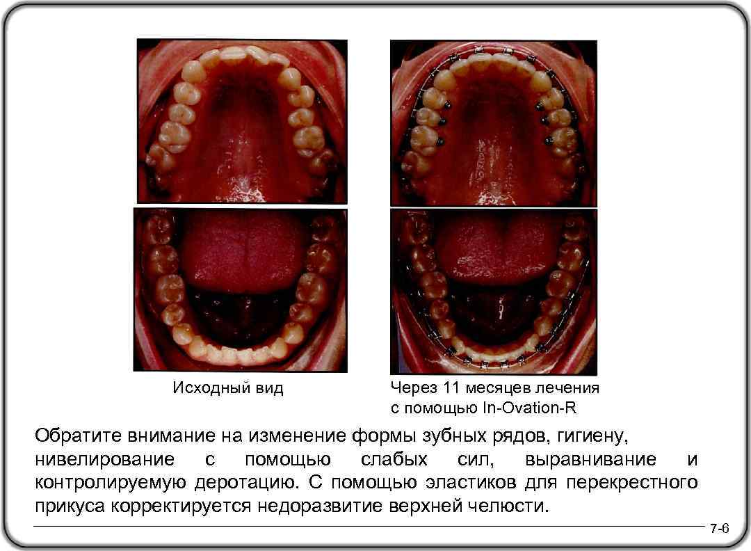 Исходный вид Через 11 месяцев лечения с помощью In-Ovation-R Обратите внимание на изменение формы