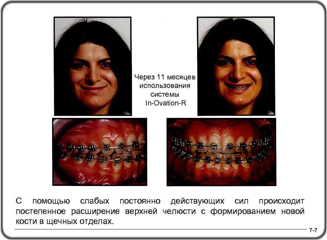 Через 11 месяцев использования системы In-Ovation-R С помощью слабых постоянно действующих сил происходит постепенное