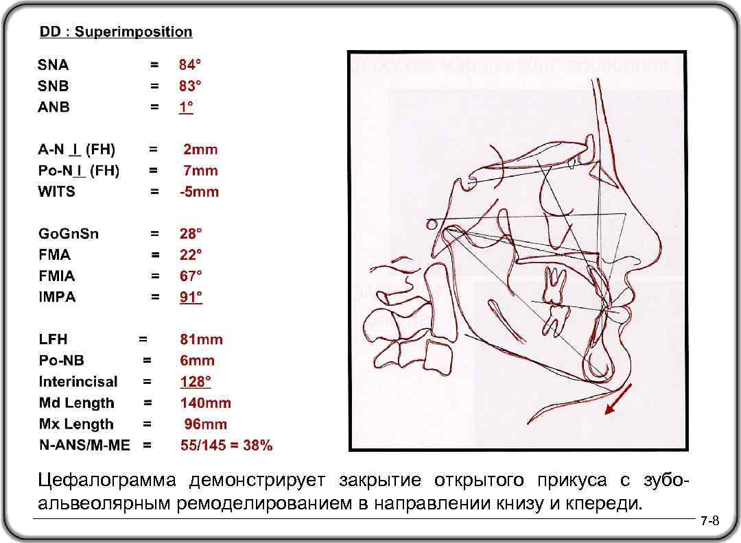 Цефалограмма демонстрирует закрытие открытого прикуса с зубоальвеолярным ремоделированием в направлении книзу и кпереди. 7