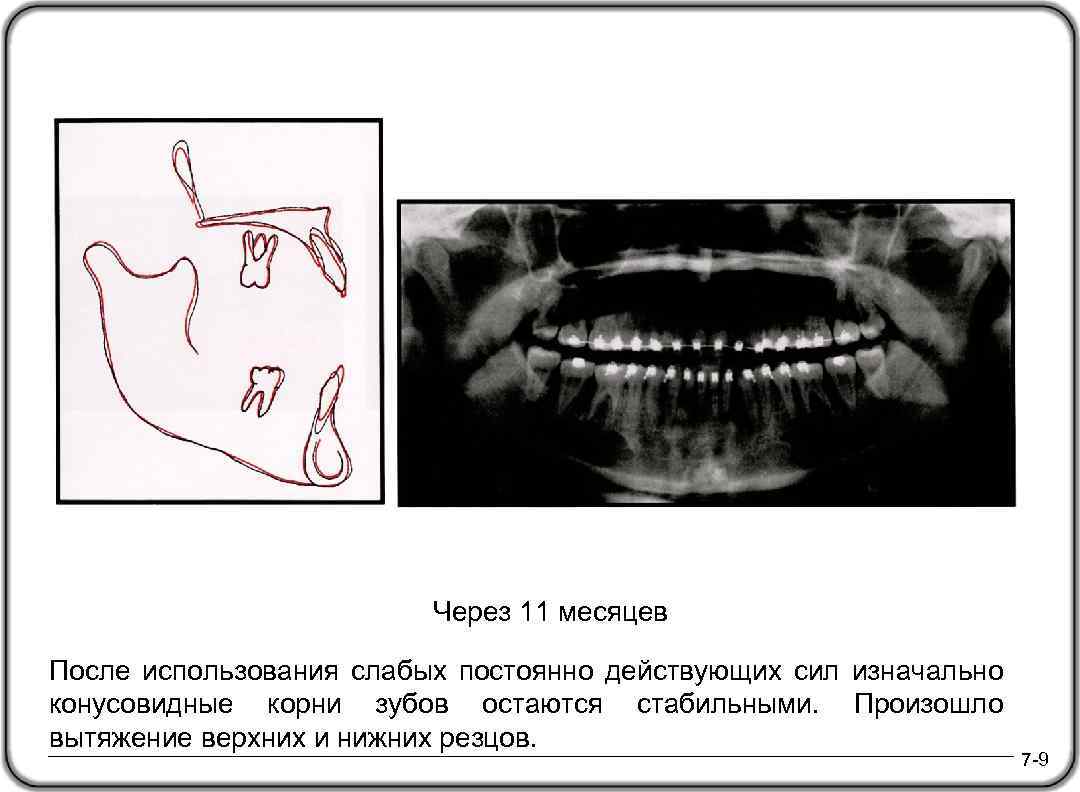 Через 11 месяцев После использования слабых постоянно действующих сил изначально конусовидные корни зубов остаются