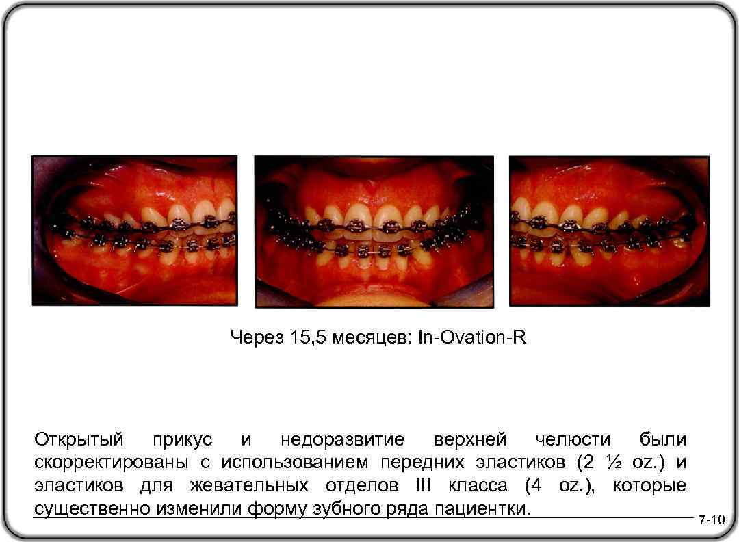 Через 15, 5 месяцев: In-Ovation-R Открытый прикус и недоразвитие верхней челюсти были скорректированы с
