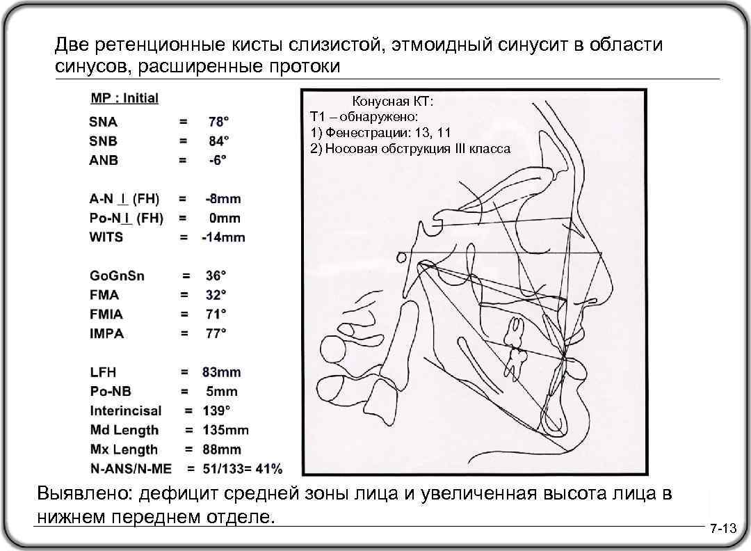 Две ретенционные кисты слизистой, этмоидный синусит в области синусов, расширенные протоки Конусная КТ: T