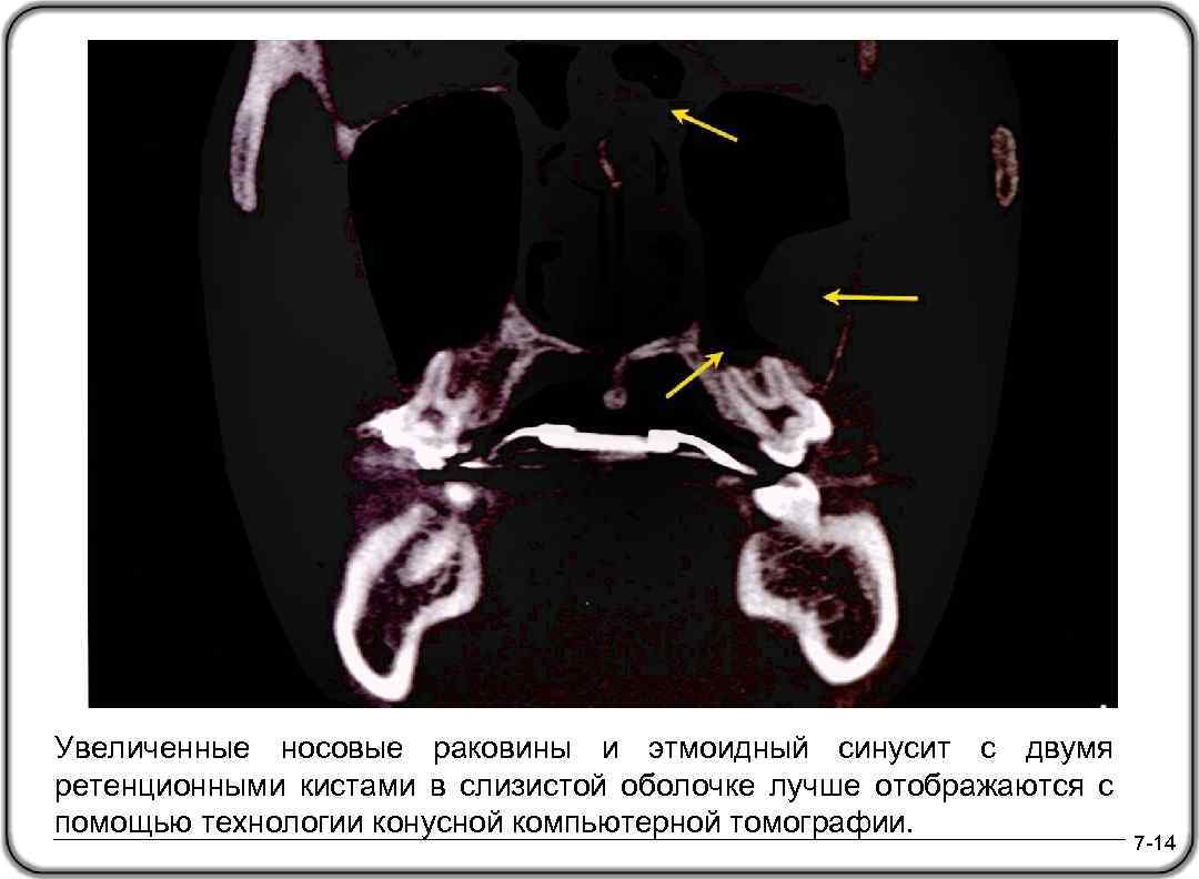 Увеличенные носовые раковины и этмоидный синусит с двумя ретенционными кистами в слизистой оболочке лучше