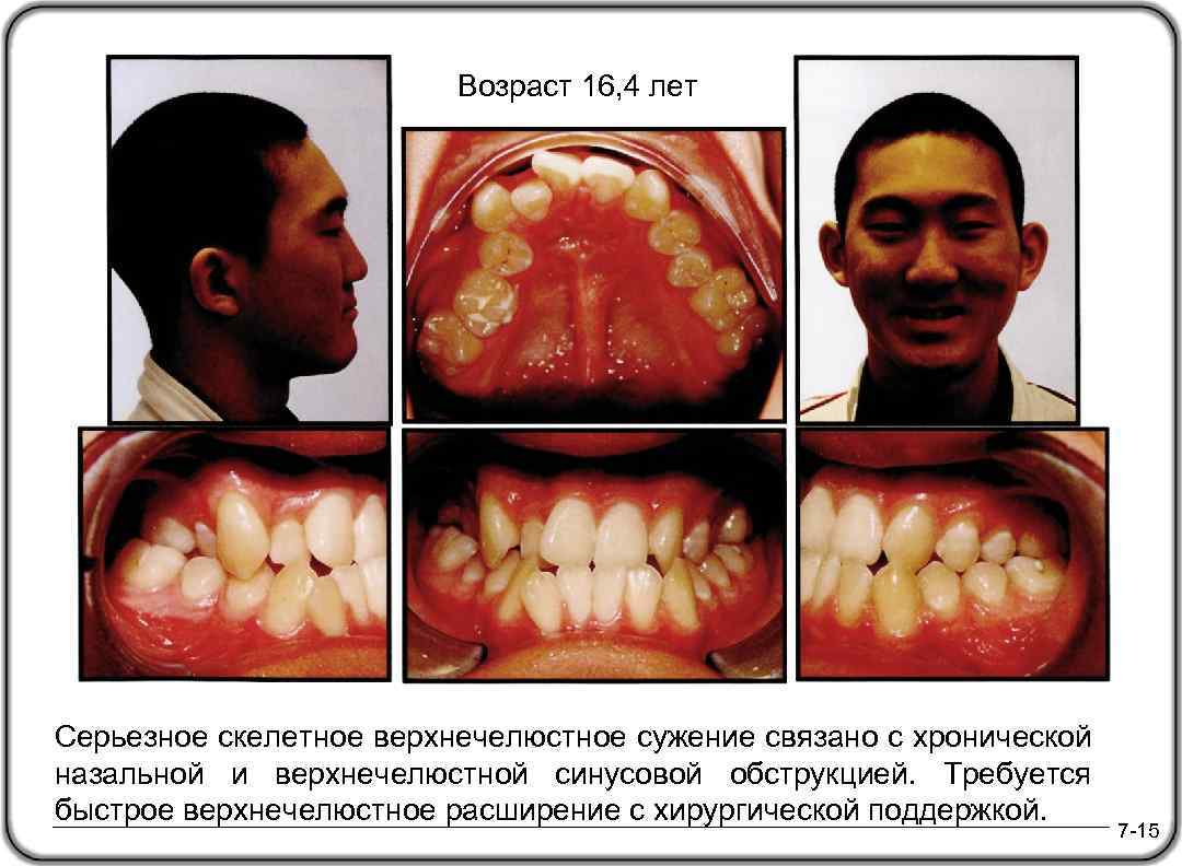 Возраст 16, 4 лет Серьезное скелетное верхнечелюстное сужение связано с хронической назальной и верхнечелюстной
