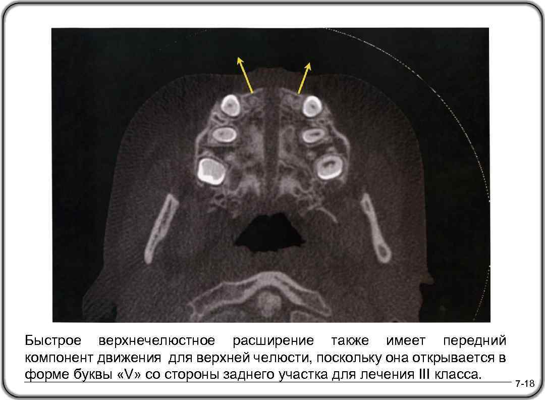 Быстрое верхнечелюстное расширение также имеет передний компонент движения для верхней челюсти, поскольку она открывается