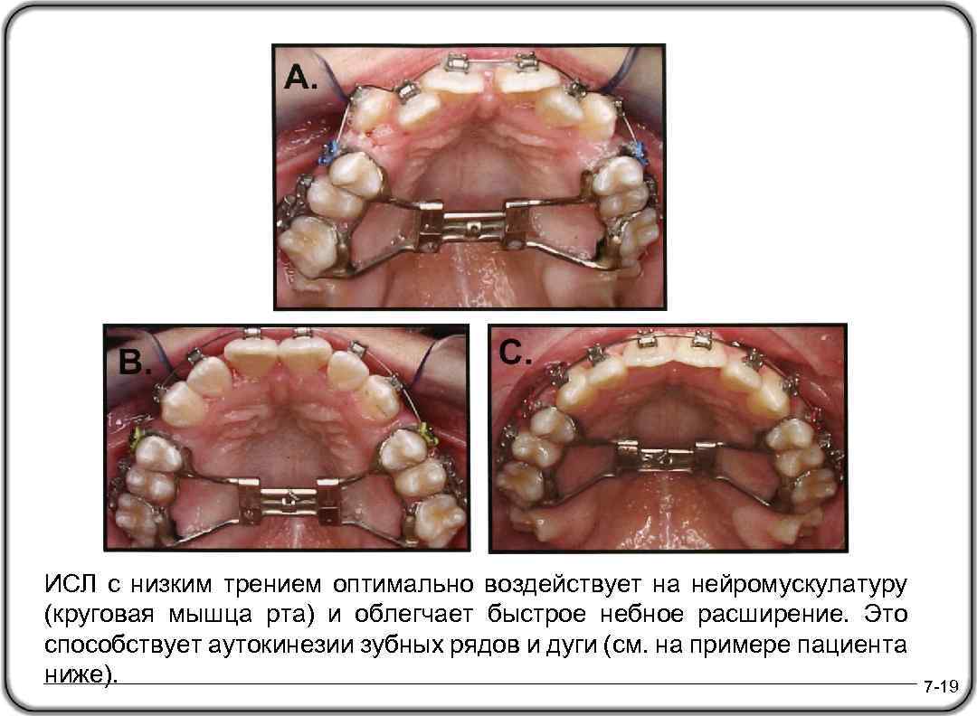 ИСЛ с низким трением оптимально воздействует на нейромускулатуру (круговая мышца рта) и облегчает быстрое