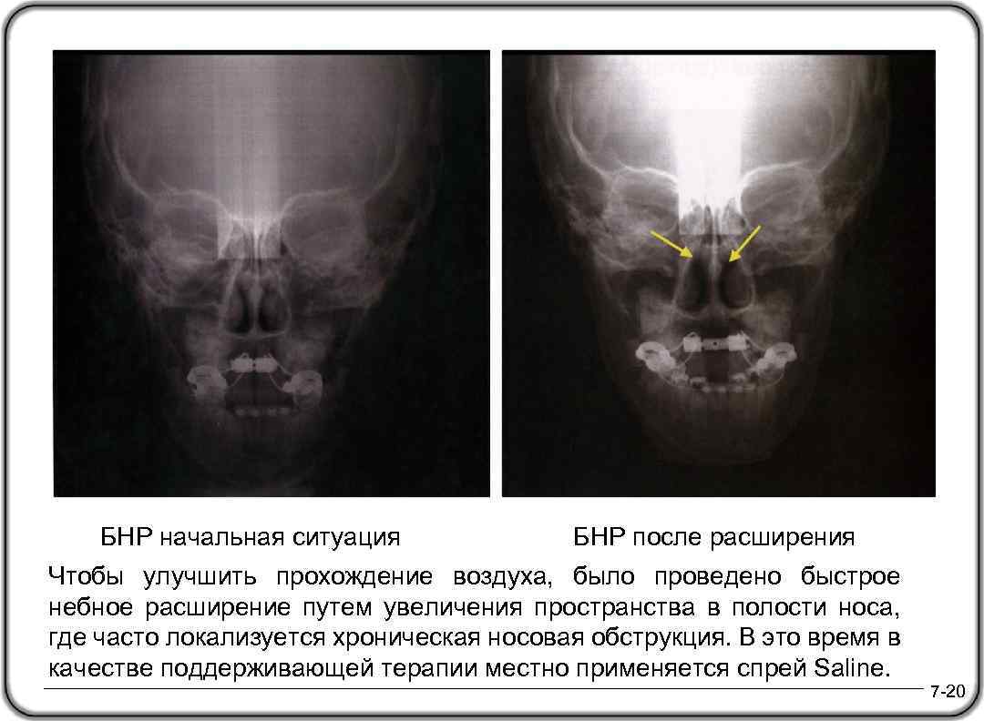 БНР начальная ситуация БНР после расширения Чтобы улучшить прохождение воздуха, было проведено быстрое небное