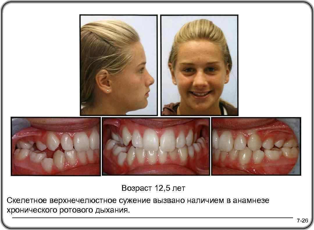 Возраст 12, 5 лет Скелетное верхнечелюстное сужение вызвано наличием в анамнезе хронического ротового дыхания.