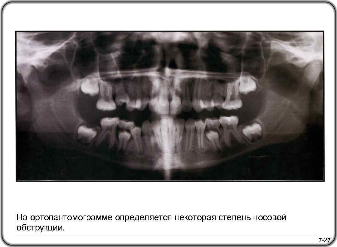 На ортопантомограмме определяется некоторая степень носовой обструкции. 7 -27 