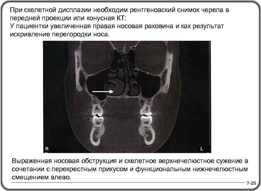 При скелетной дисплазии необходим рентгеновский снимок черепа в передней проекции или конусная КТ: У